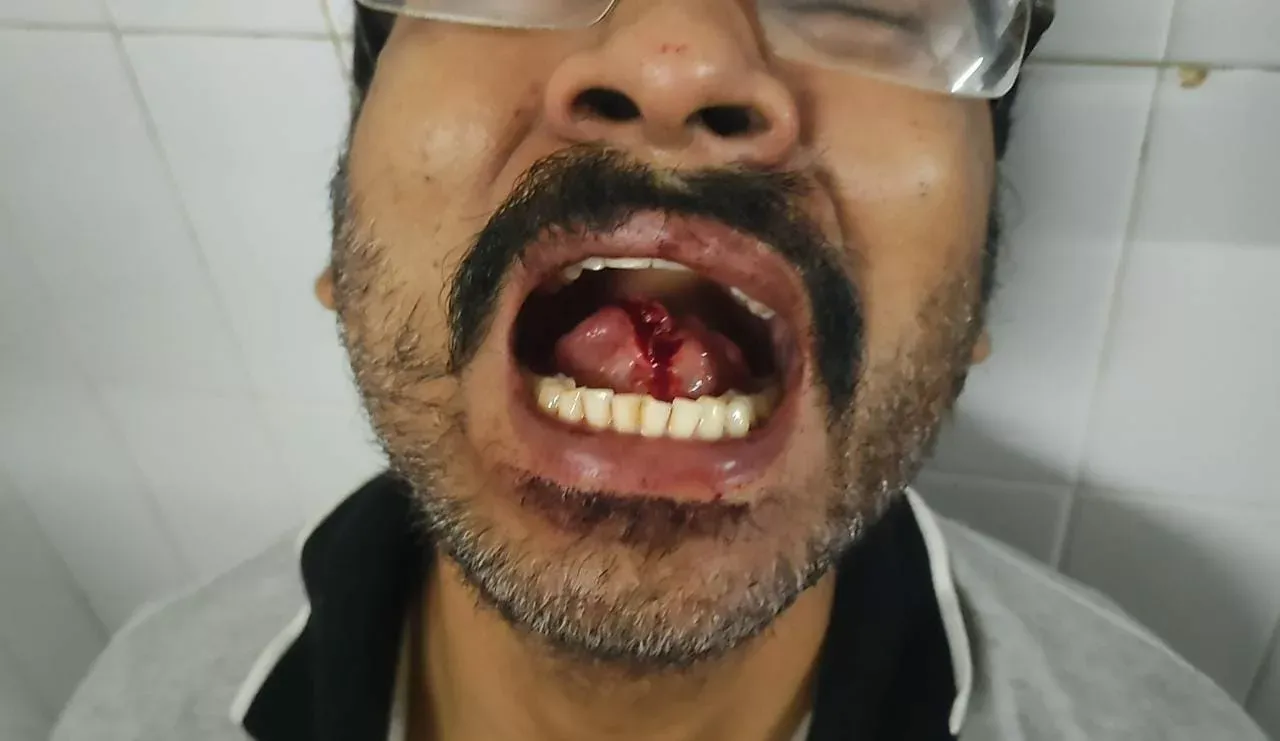 ముద్దు పెట్టుకున్నందుకు భర్త నాలుక కొరికేసిన భార్య
