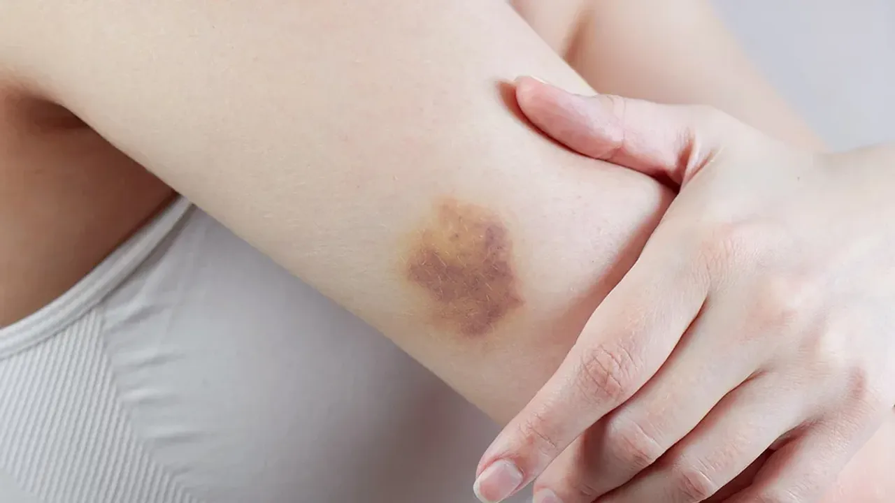 Bruises: శరీరంలో గాయం మచ్చ పోవట్లేదా? జస్ట్ ఇలా చేస్తే చాలు మరక మాయం..!