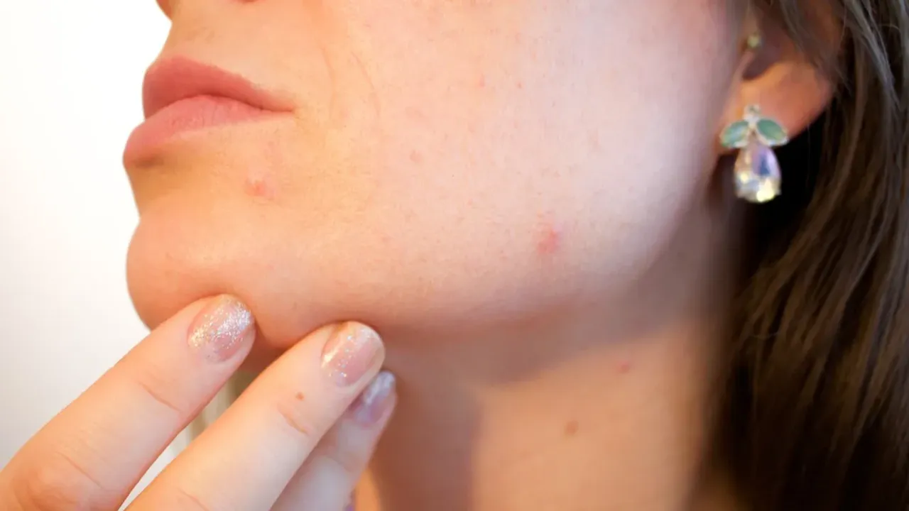Beauty Tips: బ్లాక్ హెడ్స్ సింపుల్‌గా తొలగించే చిట్కాలు