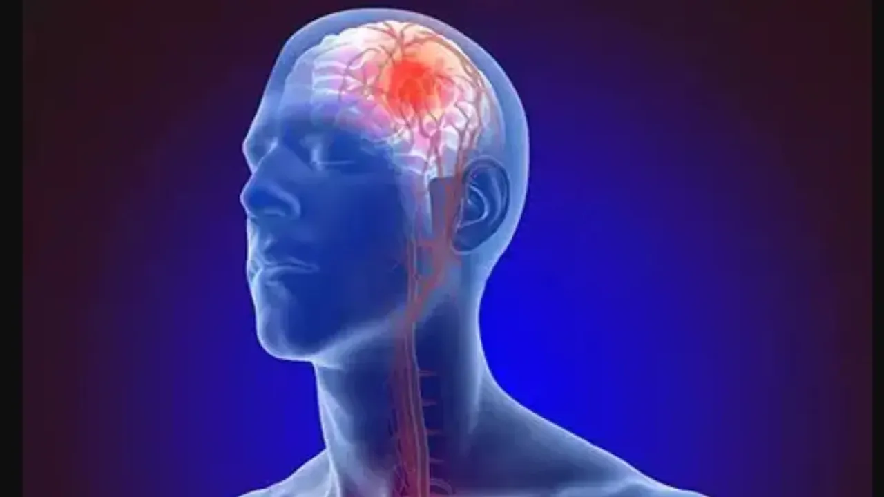 Brain stroke: బ్రెయిన్ స్ట్రోక్ లక్షణాలు ఇవే.. జాగ్రత్తలు తీసుకోకపోతే అంతే సంగతులు