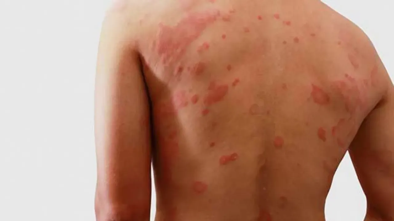 Skin Rashes: ఒత్తిడి ఎక్కువైతే శరీరంలో జరిగే మార్పులు ఇవే..దీర్ఘకాలిక సమస్యలు తప్పవా..?