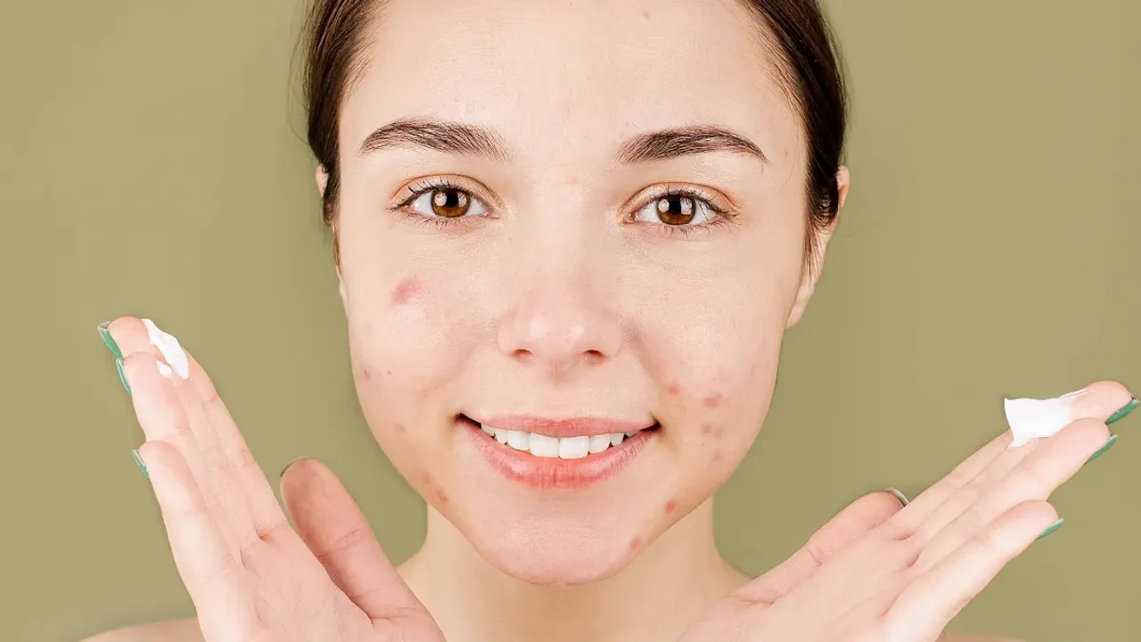 Pimple remove tips: మొటిమల నివారణకు ఇంటి చిట్కాలు.. ఇవి ట్రై చేసి చూడండి!