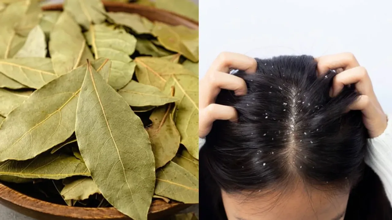Bay leaves Tips: ఈ ఆకుతో.. డాన్డ్రప్ సమస్య దెబ్బకు మాయం