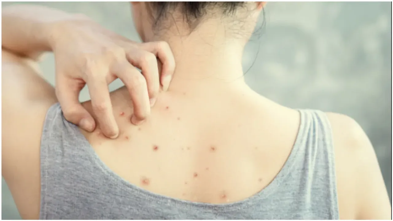 Back Acne: వీపు, బాడీ పై పింపుల్స్ వస్తున్నాయా.. అయితే ఇలా చేయండి..!