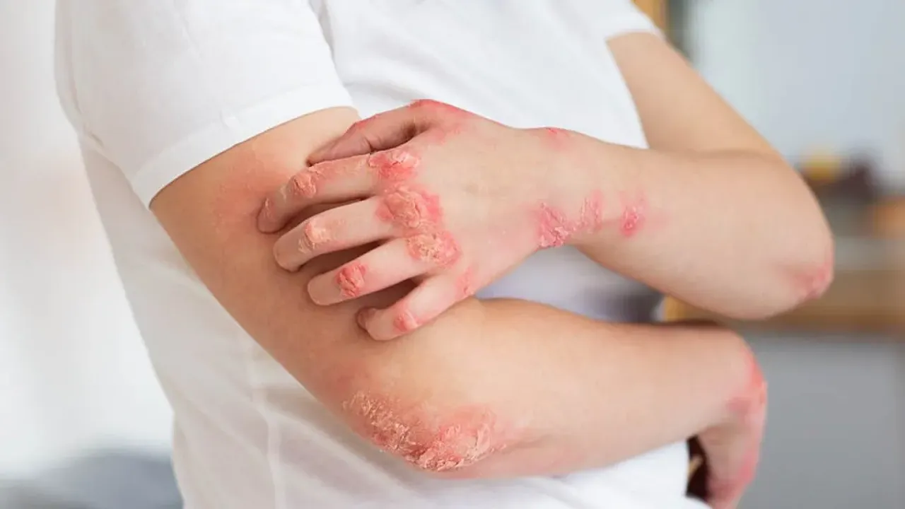 Skin Infection: స్కిన్ ఇన్ఫెక్షన్ చాలా ఇరిటేటింగ్.. ఇది బెటర్ రిలీఫ్ ఆప్షన్