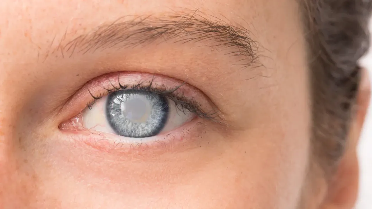 Cataract: పిల్లలకు కంటిశుక్లం ఎందుకు వస్తుంది..లక్షణాలు ఎలా ఉంటాయి..?