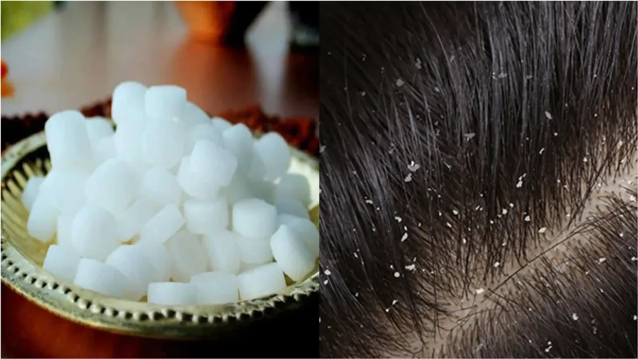 Dandruff : చుండ్రుతో బాధపడుతున్నారా? కర్పూరంతో ఇలా చేయండి..మేజిక్ చూడండి