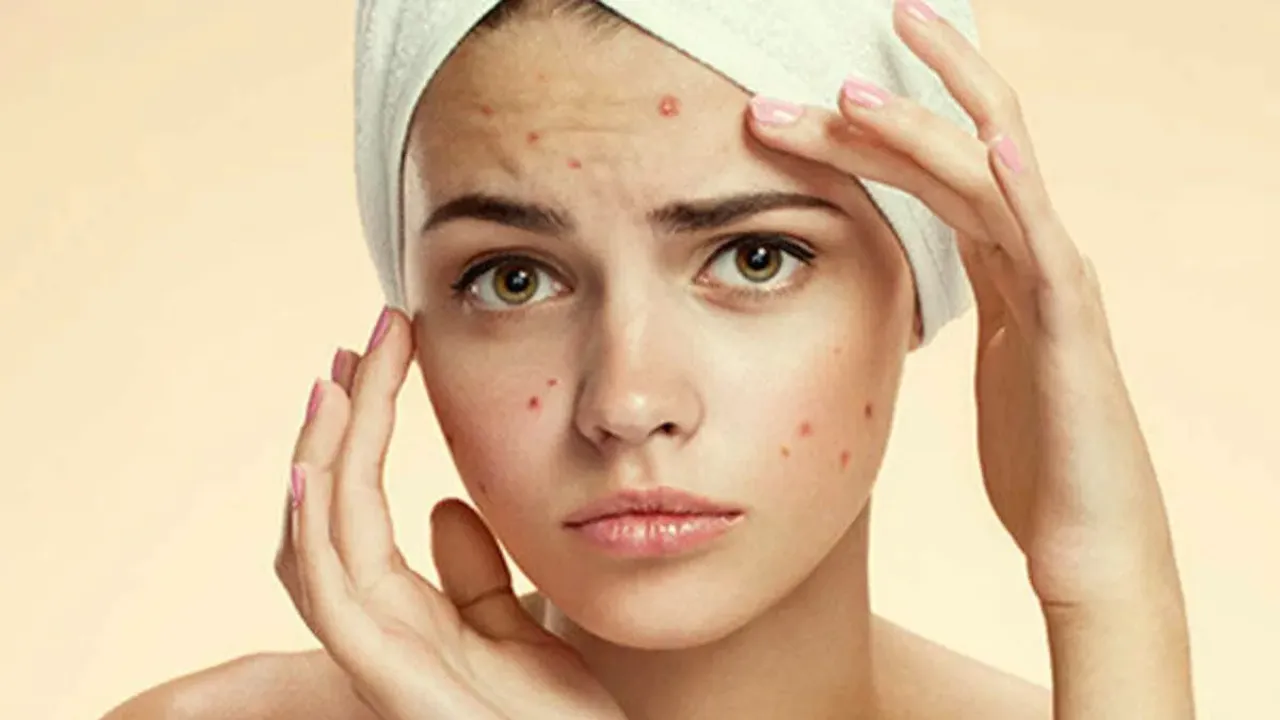 Pimples: ఈ అలవాట్లు ఉంటే.. మొటిమలు మరింత పెరుగుతాయి