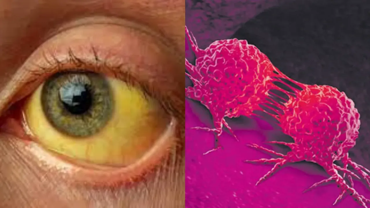Jaundice: కామెర్లు కూడా క్యాన్సర్ లక్షణమేనా?..వైద్యులు ఏమంటున్నారు?
