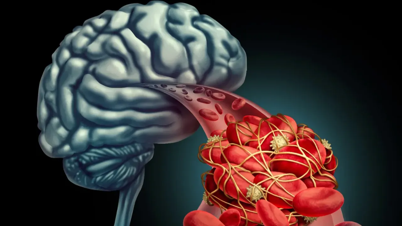 Brain Hemorrhage : మెదడులోని నరాలు పగిలితే ఏమవుతుంది?.. అలా జరగడానికి కారణాలేంటి?