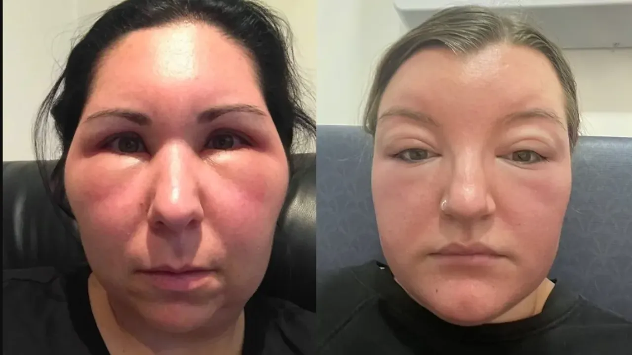 Swelling Face : ముఖం బెలూన్‌లా ఉబ్బిందా.. ఇలా చేయండి