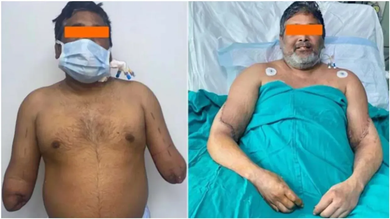 Delhi: చేతుల ట్రాన్స్‌ప్లాంటేషన్..ఢిల్లీ వైద్యుల మిరాకిల్