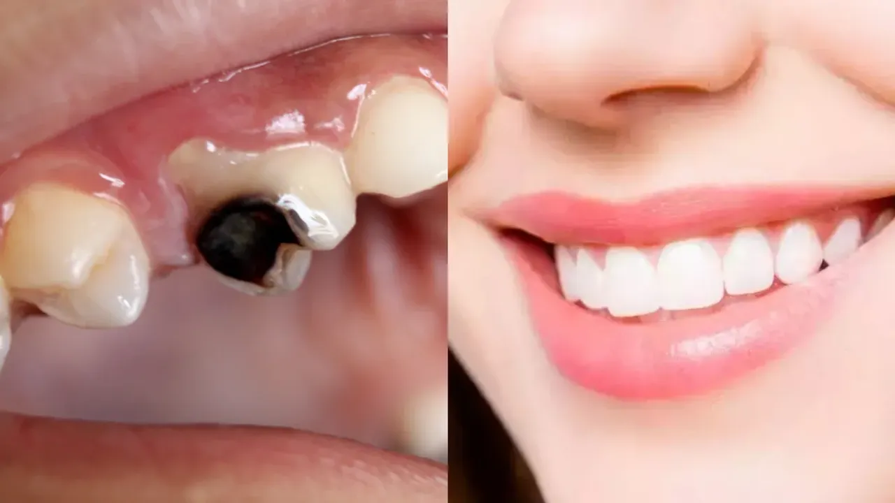 Teeth Tips: పుచ్చిన దంతాలను రిపేర్‌ చేసే టెక్నిక్‌.. కొత్తవాటిలా మెరుస్తాయి