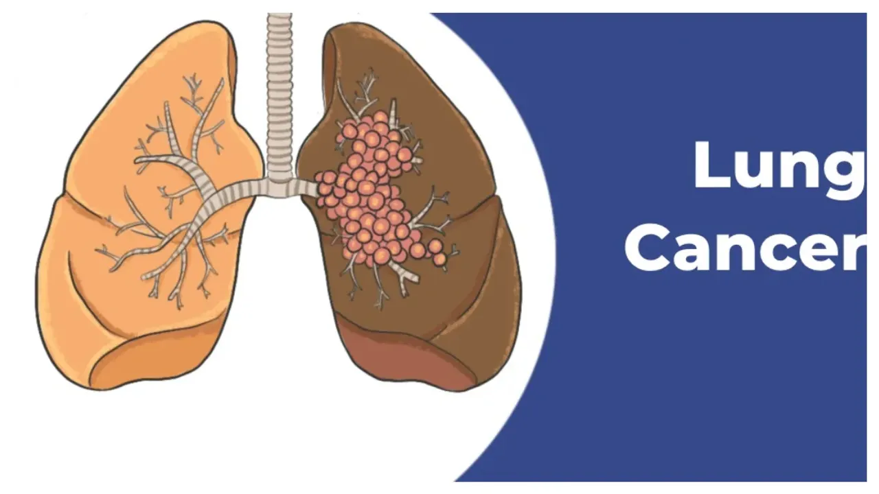 Lung Cancer: స్మోక్ చేయకపోయిన లంగ్ క్యాన్సర్!