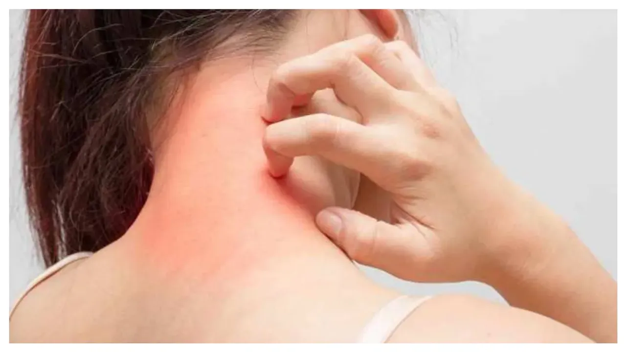 Health Tips: చెమటకాయలకు చెక్ పెడదాం ఇలా..