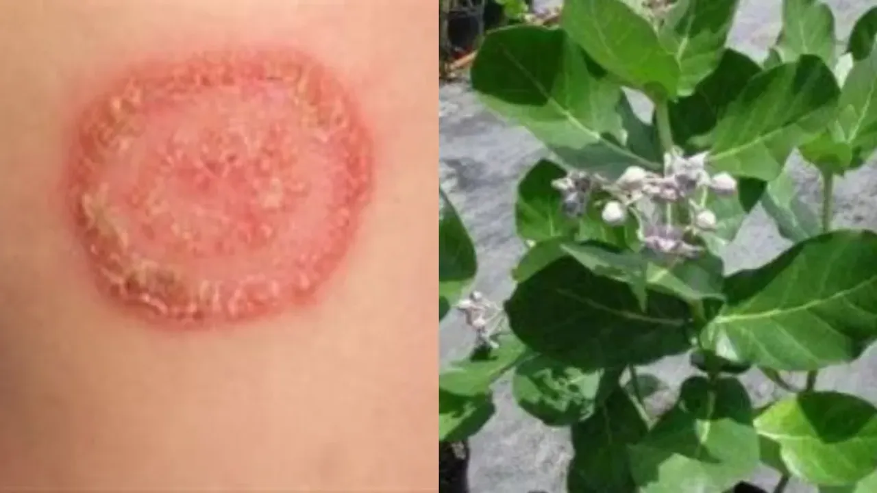 Health Tips: గజ్జి, తామరను మూడు రోజుల్లో మాయం చేసే చిట్కాలు