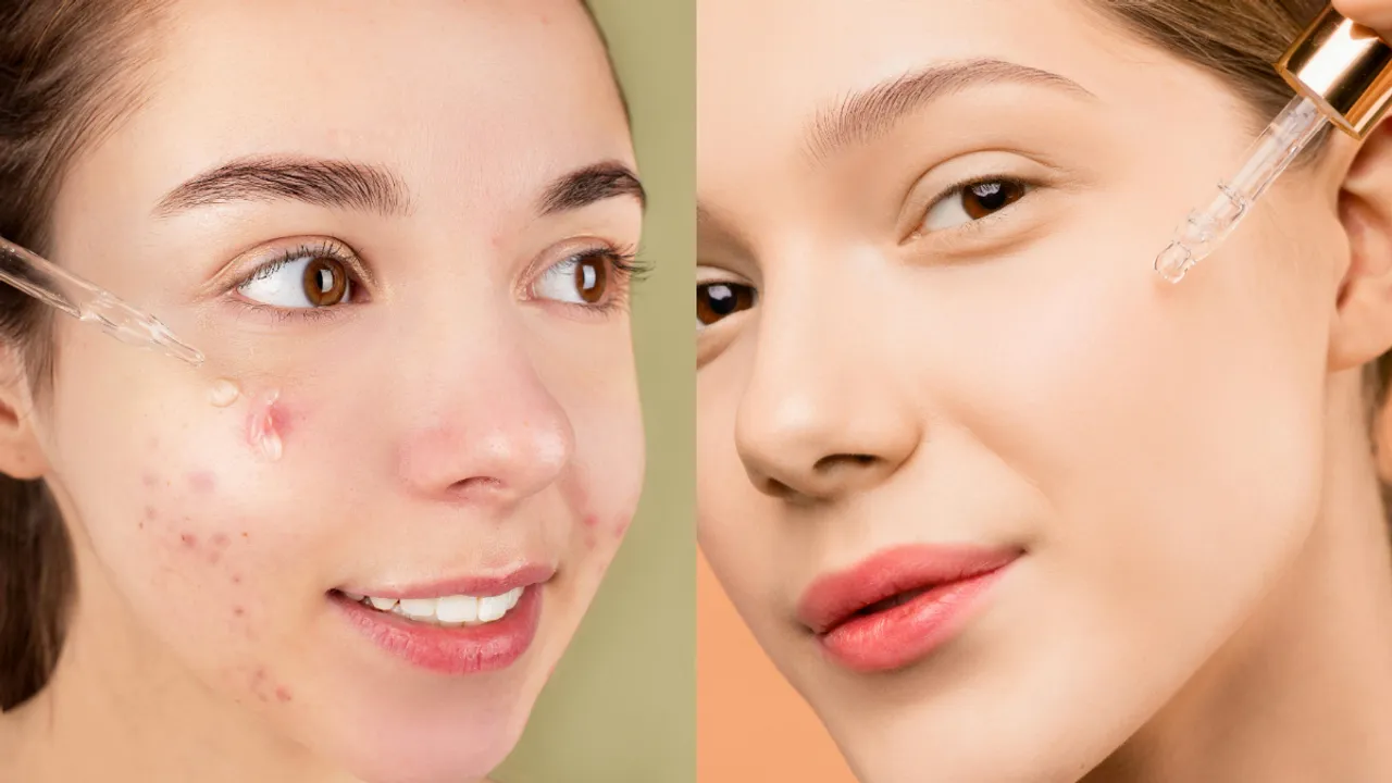 Beauty Tips: ఏళ్లనాటి మచ్చలు క్షణాల్లో పోవాలంటే.. ఈ సీరమ్‌ను వాడండి