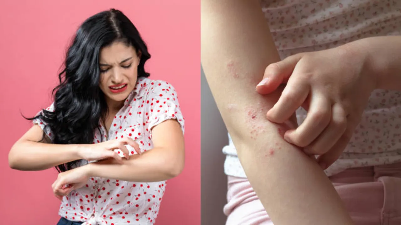 Summer Health Tips: వేడి కారణంగా కూడా అలెర్జీ వస్తుందా..? నివారణా మార్గాలను తెలుసుకోండి