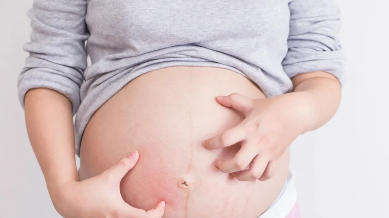 Pregnancy: ప్రెగ్నెన్సీ సమయంలో కడుపు పై దురద ఎక్కువైందా..! ఈ చిట్కాలు పాటించండి