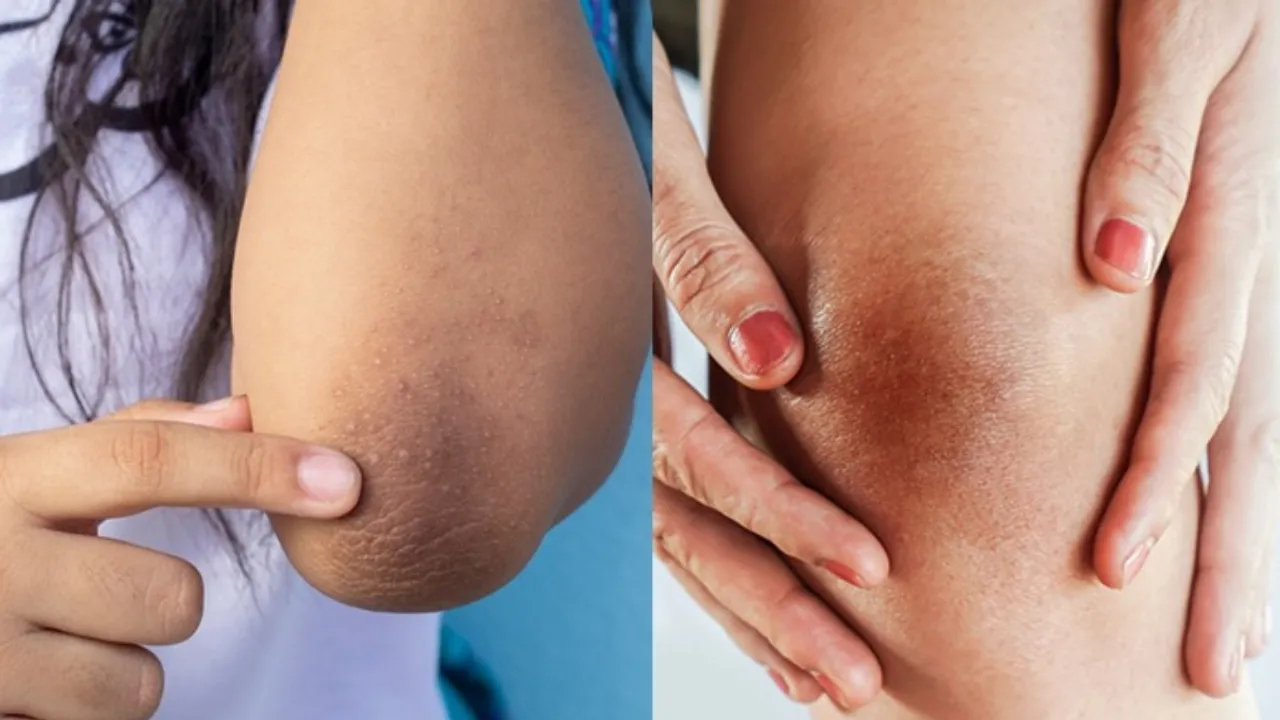 Skin Care: ఈ చిట్కాలతో నల్లటి మోకాళ్ళు, మోచేతులకు గుడ్ బాయ్ చెప్పండి..!