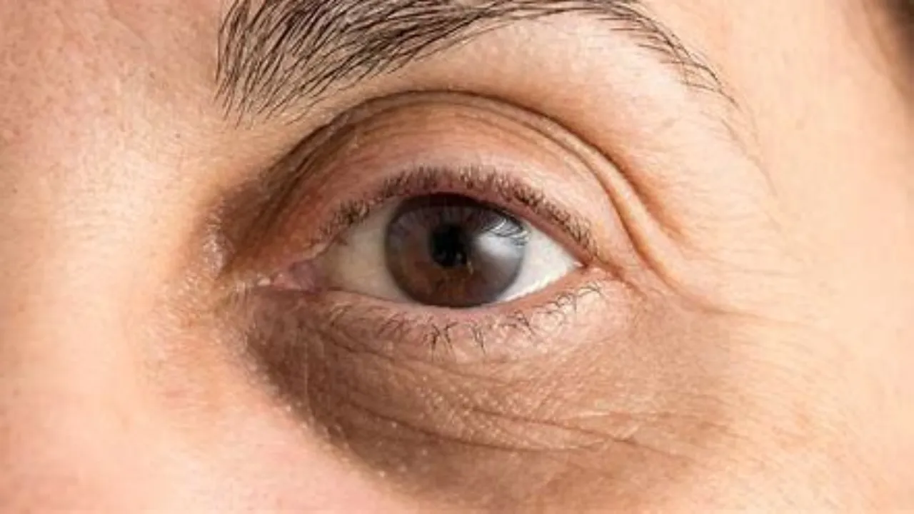 Dark Circles: వీటిని ఉపయోగించండి.. నల్లటి వలయాలను వదిలించుకోండి!