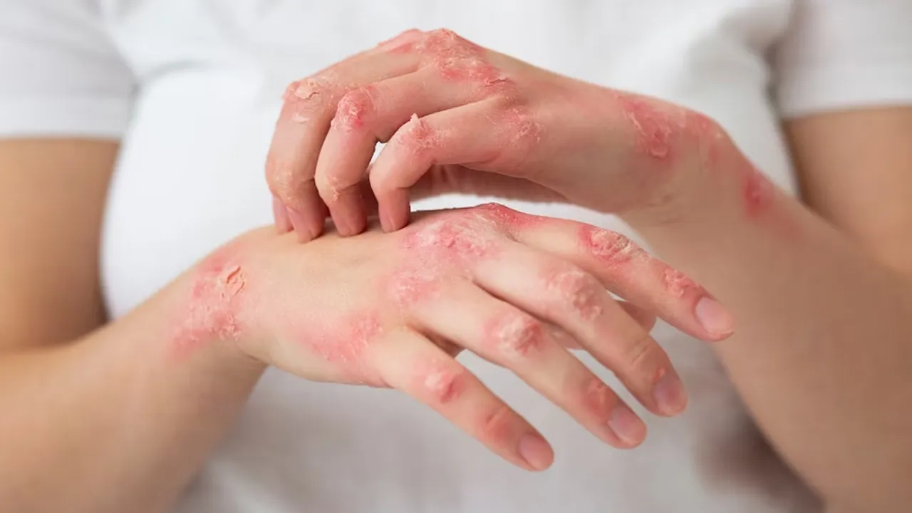 Fungal infection: ఫంగల్ ఇన్ఫెక్షన్ వల్ల ఇబ్బంది పడుతున్నారా..? ఈ ఐదు చిట్కాలు పాటించండి..!!