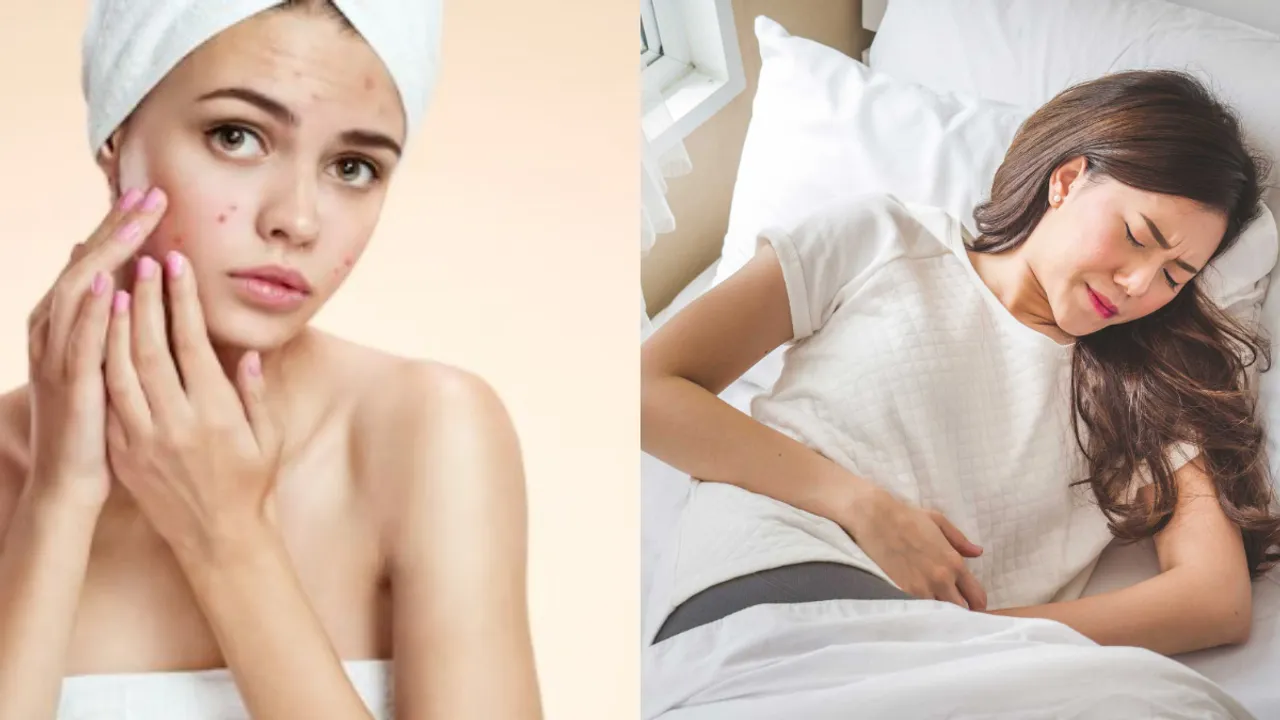 Beauty Tips: పీరియడ్స్ కారణంగా ముఖంపై మొటిమలు వస్తున్నాయా? ఇలా వదిలించుకోండి!