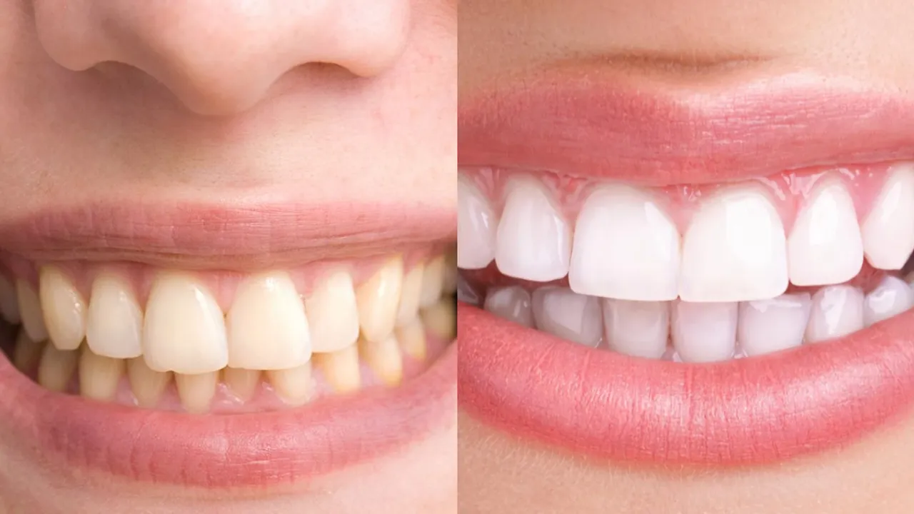 Healthy Teeth: ఈ నాలుగు పండ్లు తింటే పచ్చని పళ్ళు తళతళ మెరుస్తాయి..?