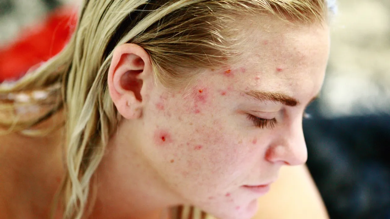 Pimple Problem: మీ ముఖంపై మొటిమలు పదేపదే కనిపిస్తున్నాయా? ఈ కారణాలు కావచ్చు!