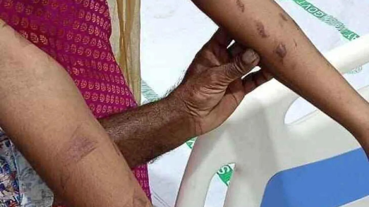 AP: కడపలో అమానుషం.. కుమార్తె చేతులపై వాతలు పెట్టిన కసాయి తల్లి..!