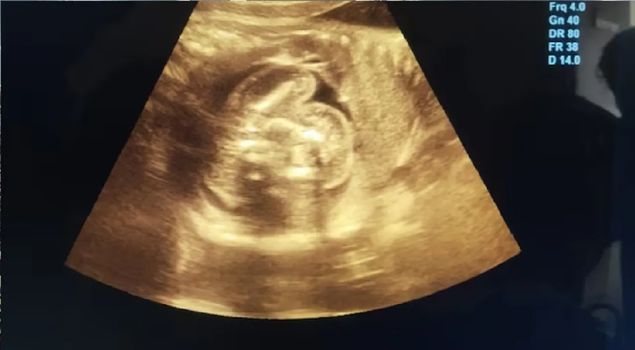 In one of 200 cases globally, foetus found inside unborn baby in Maharashtra