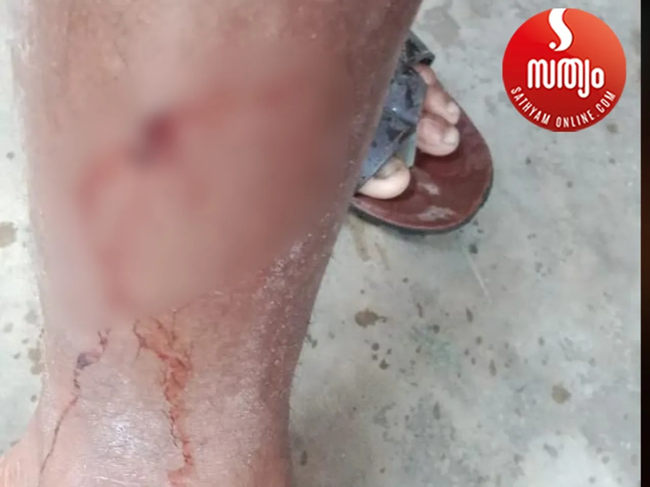 dog bite
