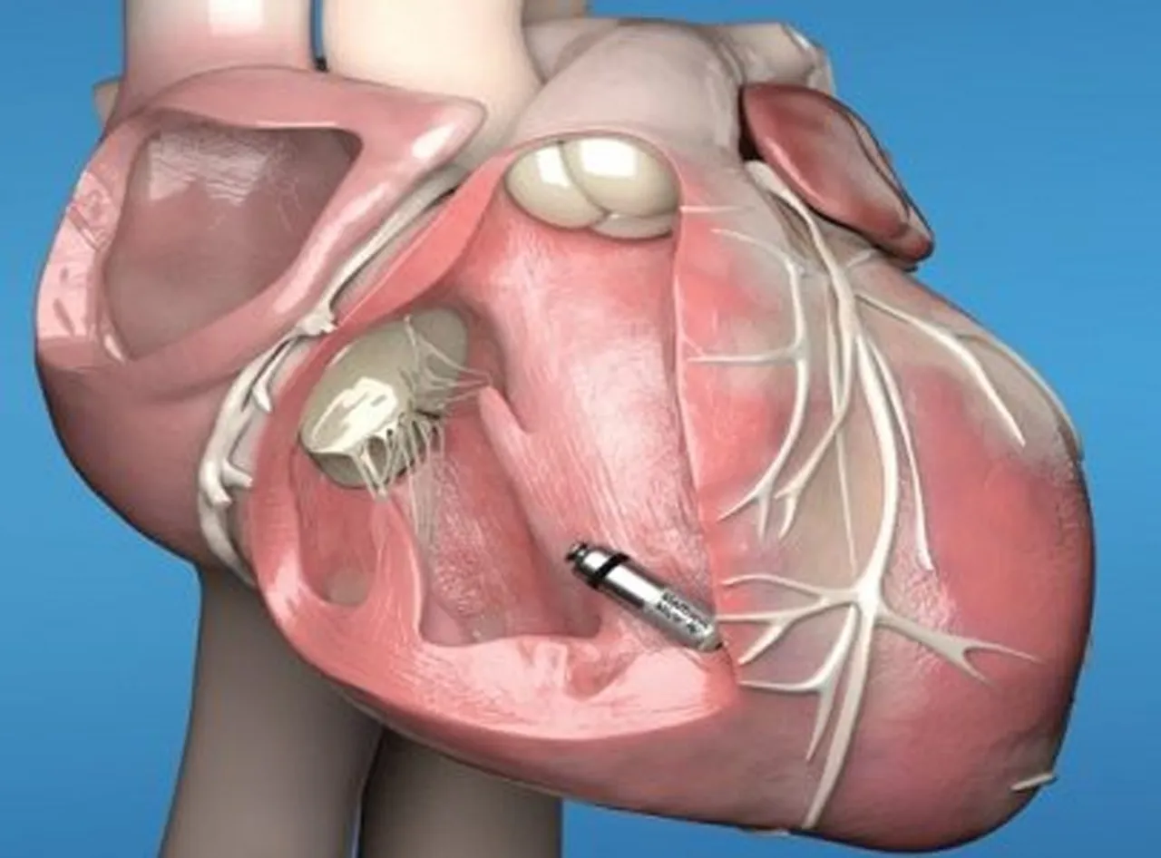abbott pacemaker