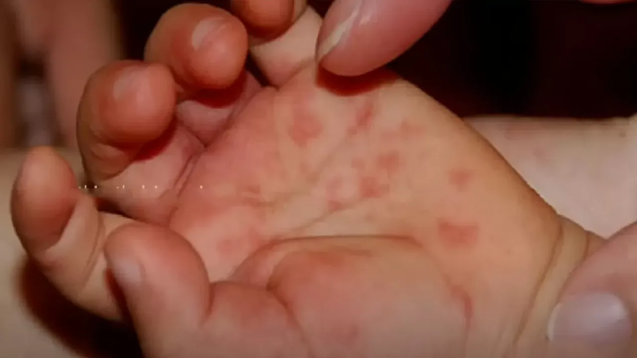 symptoms_tomato_fever_kerala_82_cases