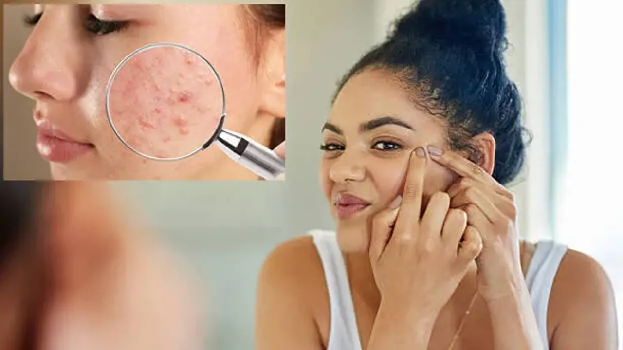 pimples-.1.2126819