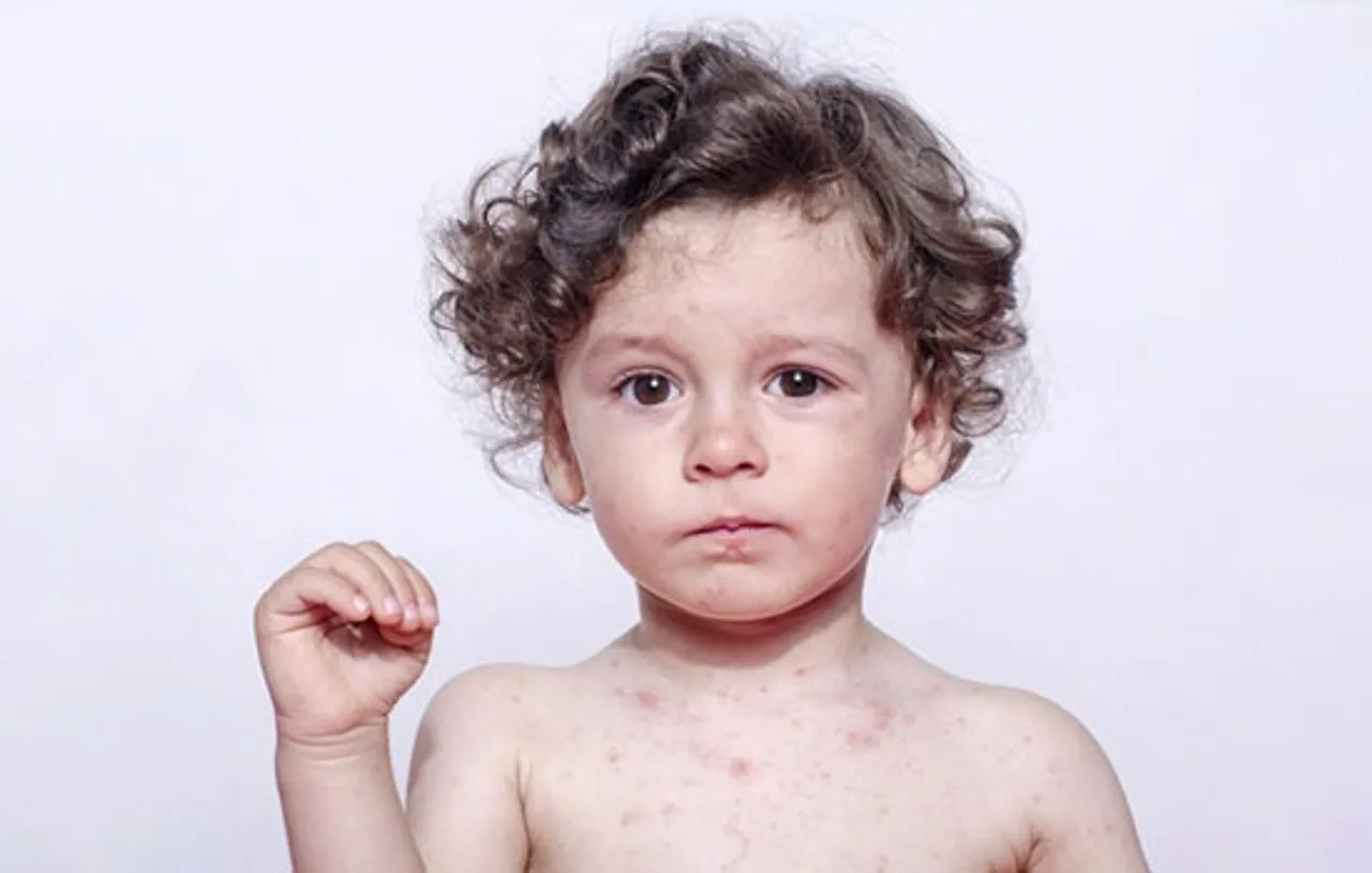 Dermatitis_Kids_550