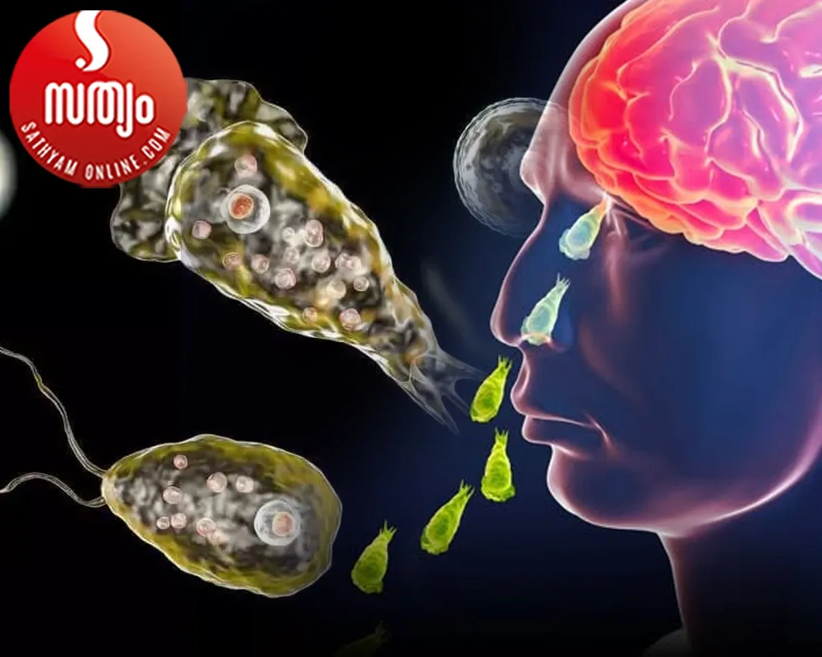 amoebic meningoencephalitis-2