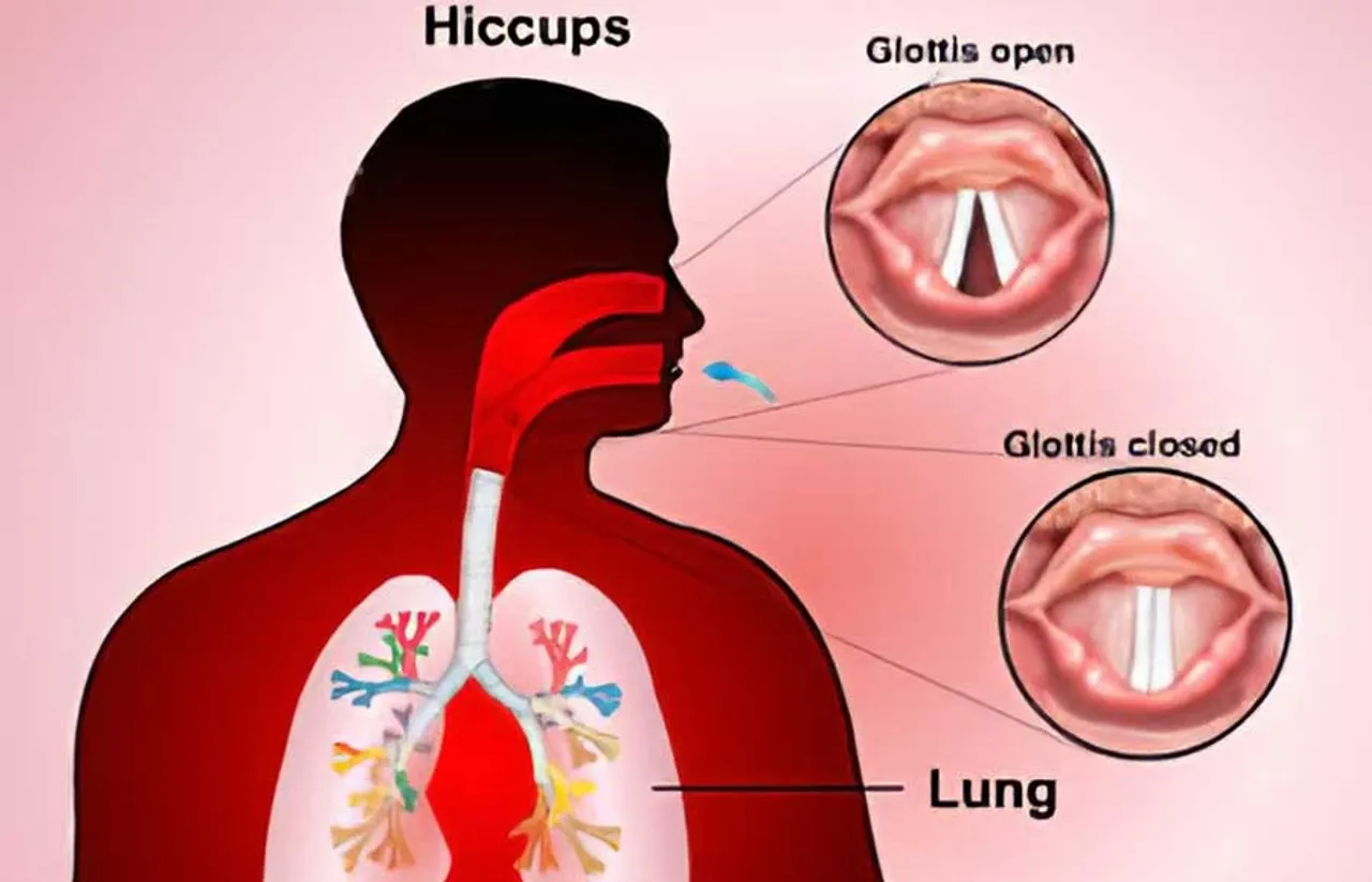 hiccups