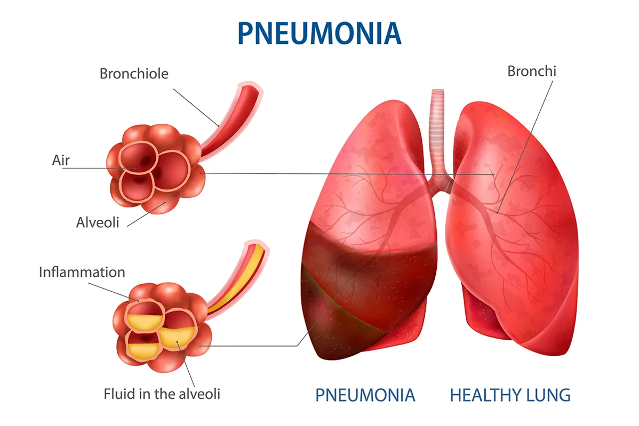 Pneumonia-1