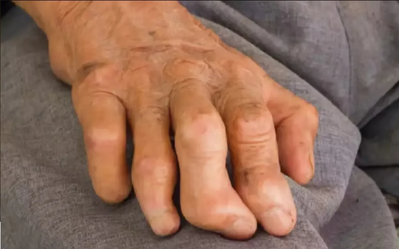 leprosy