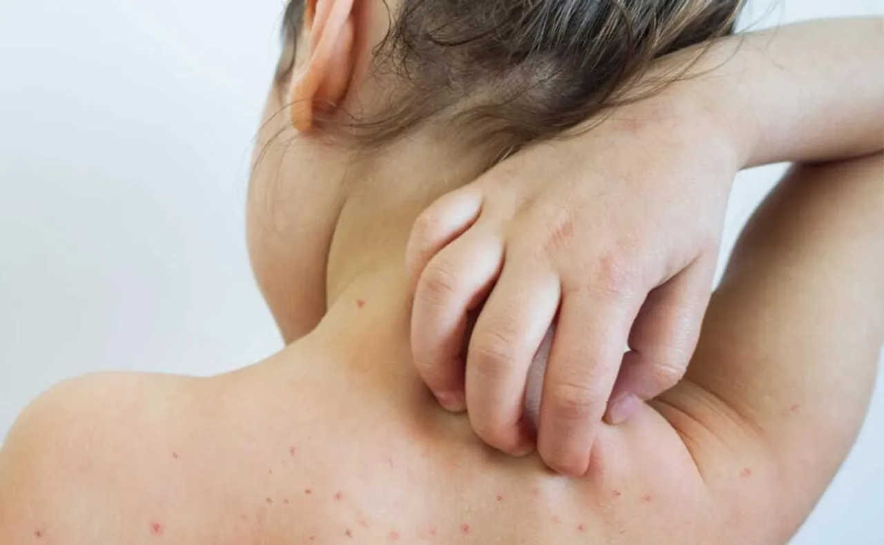 Measles