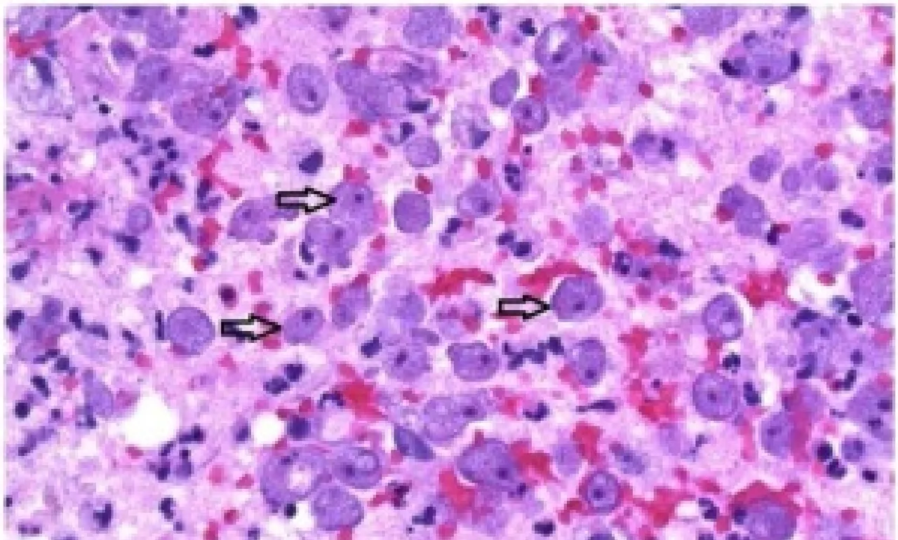amebic meningoencephalitis