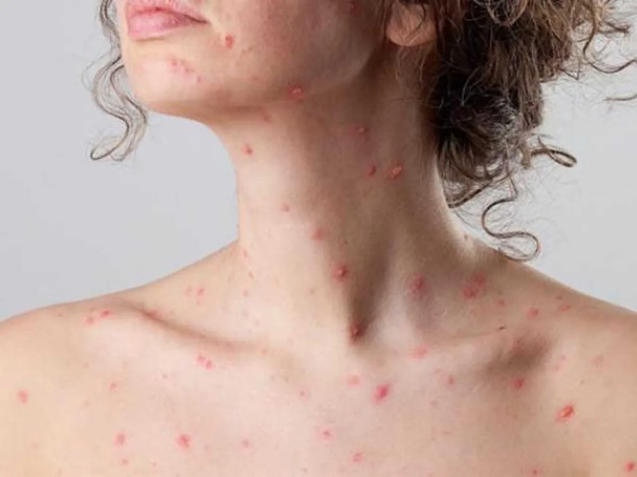 chicken pox.jpg