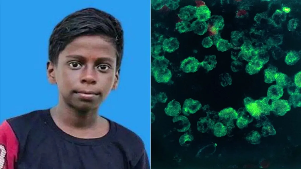 amoebic-encephalitis