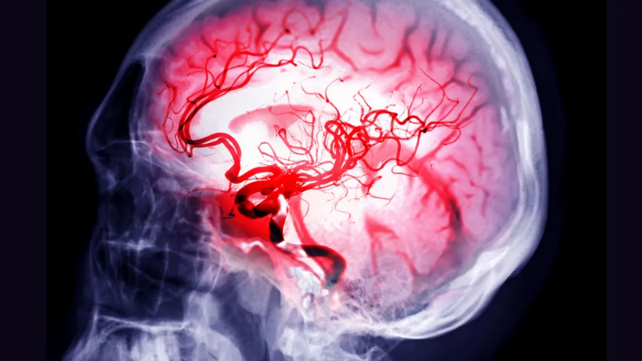 brain aneurysm