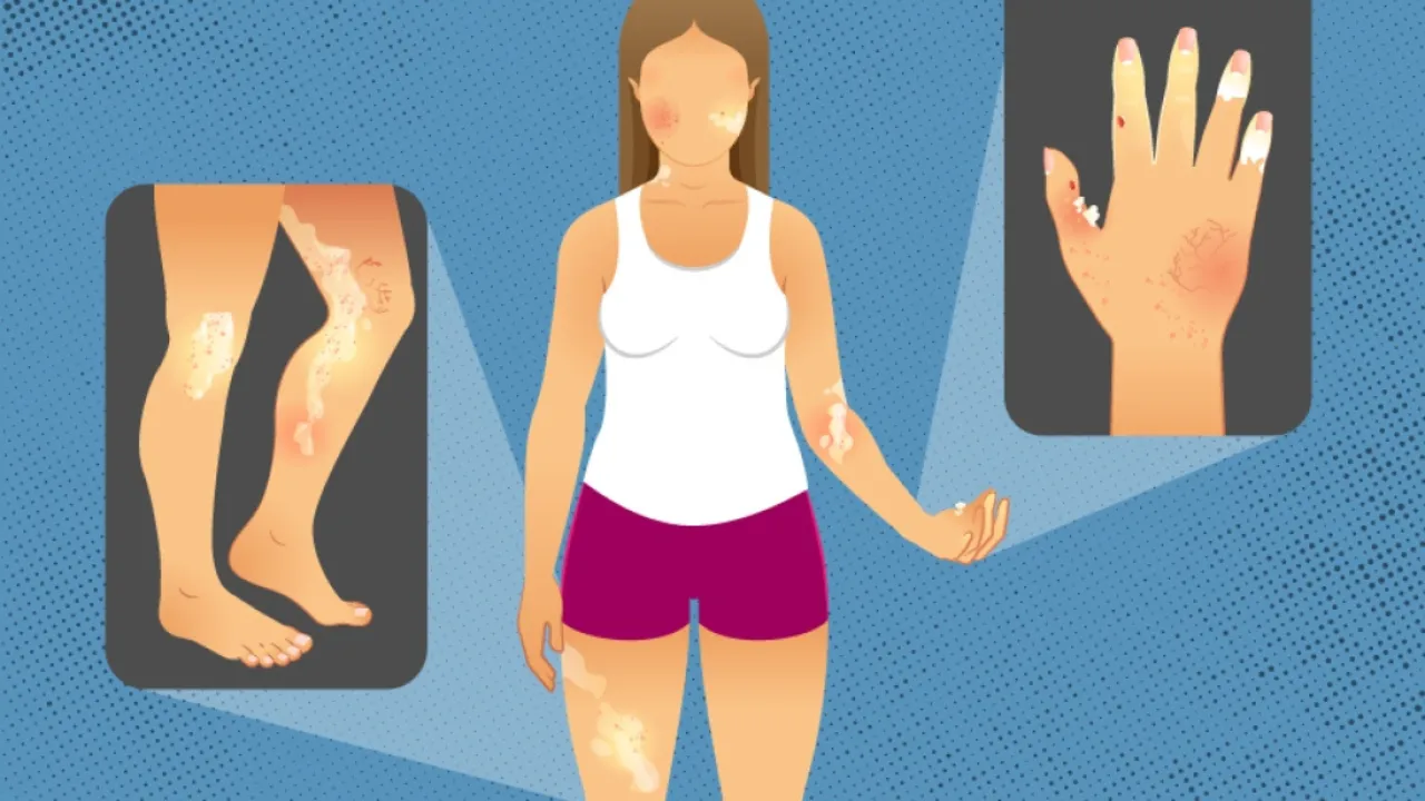 Scleroderma | credit: Michigan Medicine.png