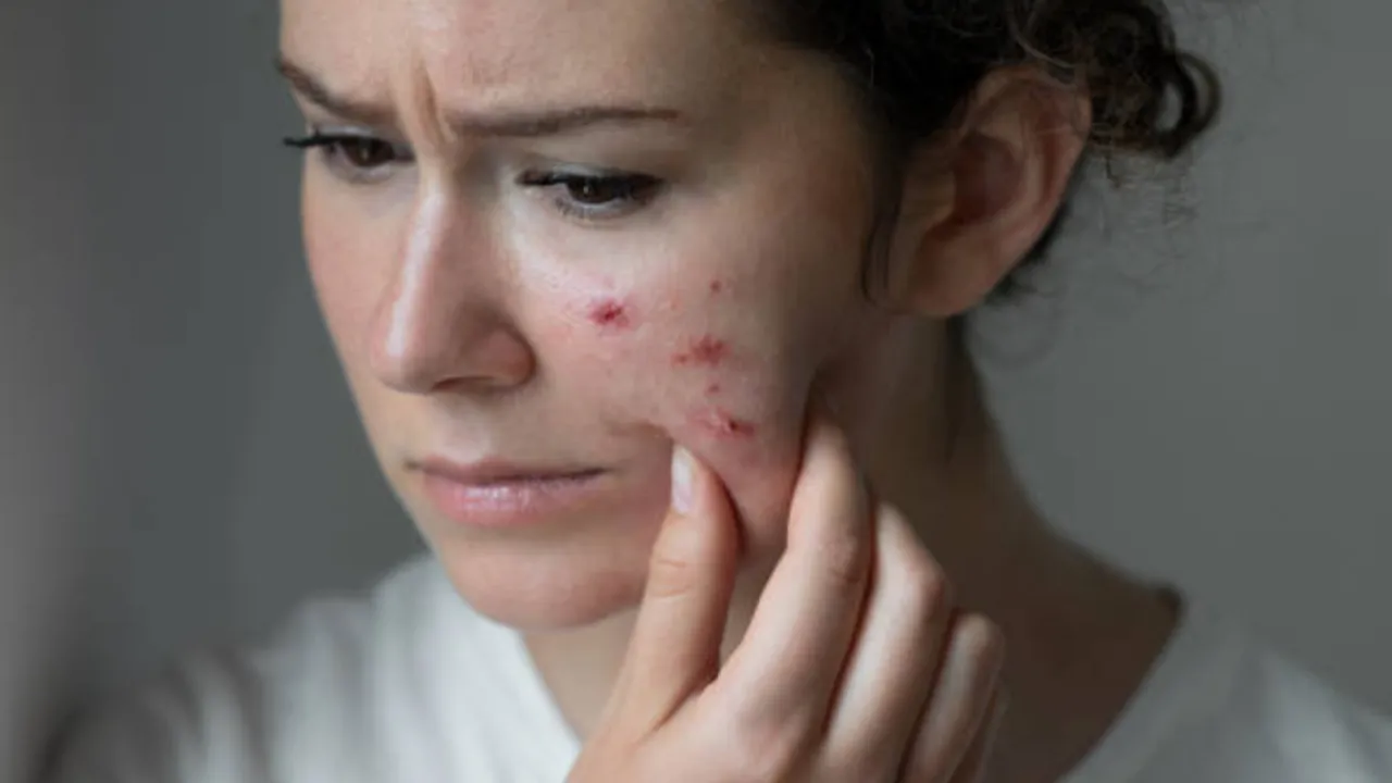 Oily Skin, bymuratdeniz | Credit: Getty Images