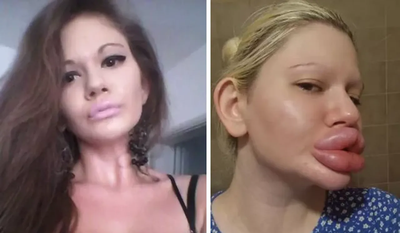 Woman Undergoes Six Lip Surgeries in One Day, Spends 21 Lakhs