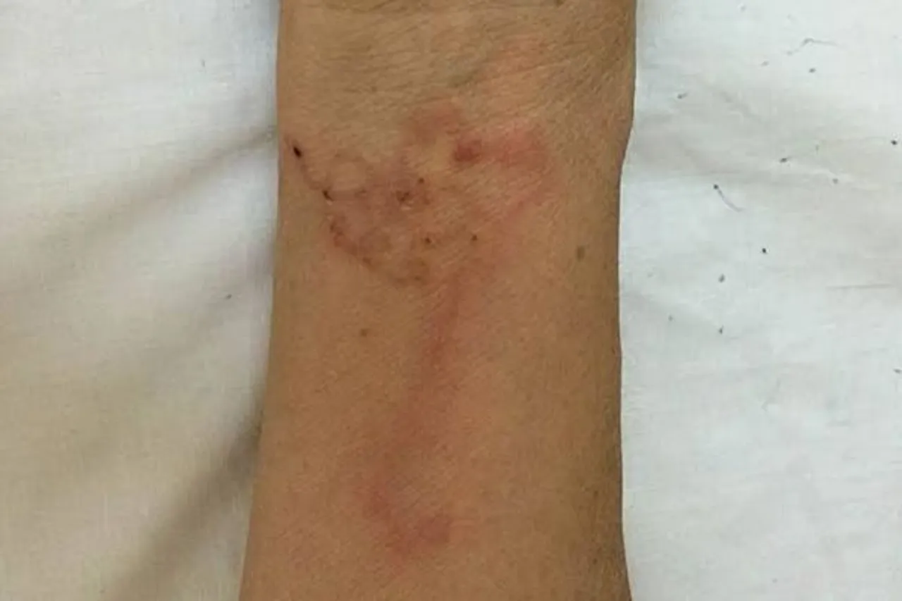 vietnamese woman gets worms in her skin