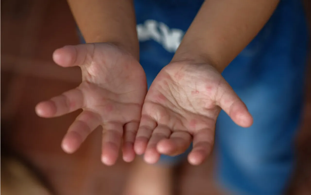 hand foot and mouth disease